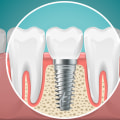 Emergency Dentist In Kansas City: Quick Relief For Dental Implants