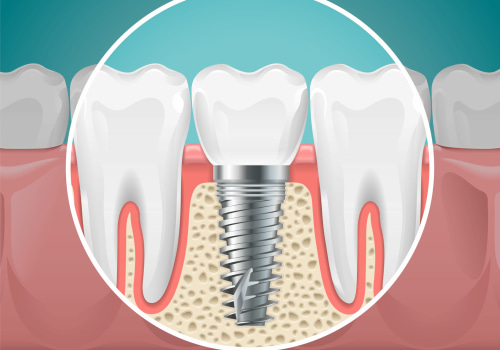 Emergency Dentist In Kansas City: Quick Relief For Dental Implants